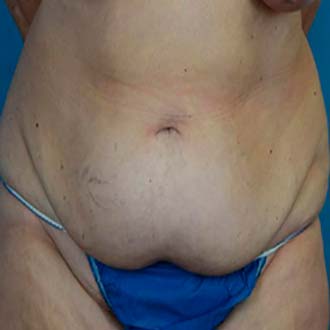 Female body, before Tummy Tuck treatment, front view, patient 1
