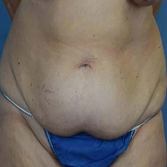 Woman’s body, before Liposuction treatment, front view