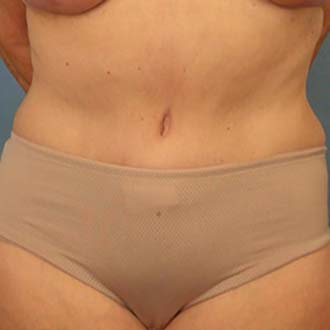 Woman’s body, after Liposuction treatment, front view