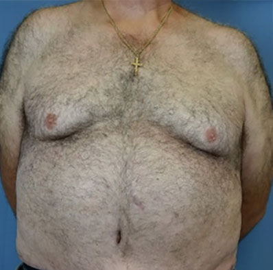 Male body, after Liposuction treatment, front view