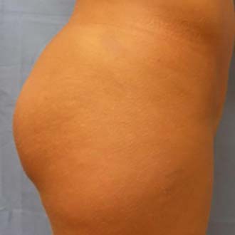 Woman’s Butt, after Brazilian Butt Lift treatment, side view