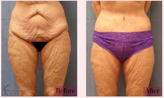 Woman's body, before and after Body Lift treatment, front view