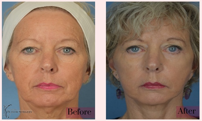 Woman's face, before and after Facelift treatment, front view