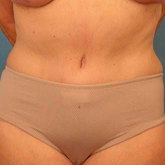 Female body, after Tummy Tuck treatment, front view, patient 1
