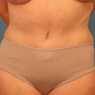 Tummy Tuck Revision Surgery Tampa FL