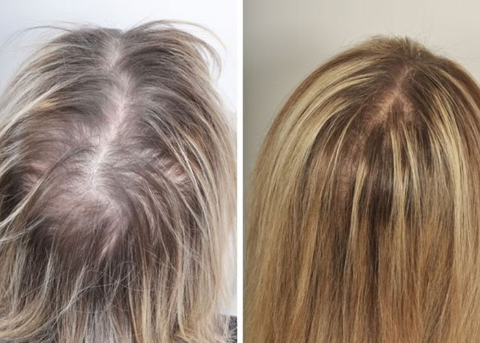 Female head, before and after Platelet-rich plasma therapy, back view