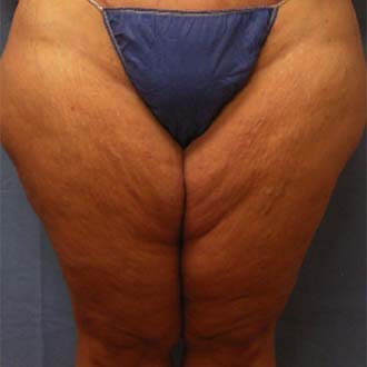 Female body, before Thigh Lift treatment, front view