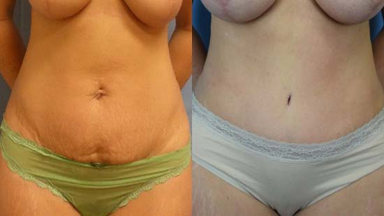  Female body, before and after Tummy Tuck treatment, front view, patient 1