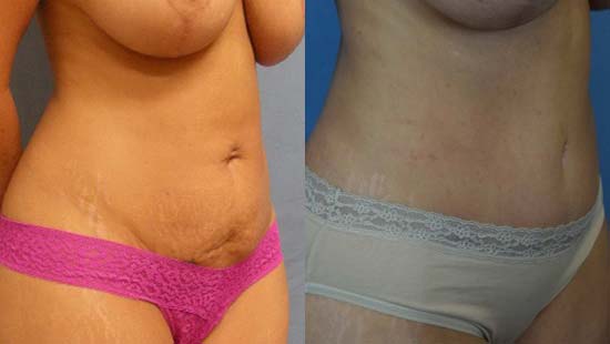 Female body, before and after Tummy Tuck treatment, r-side oblique view, patient 9