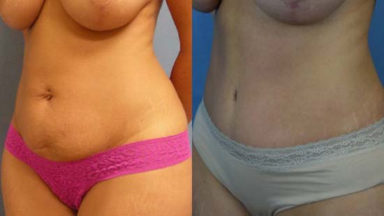 Female body, before and after Tummy Tuck treatment, l-side oblique view, patient 9