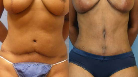 Female body, before and after Tummy Tuck treatment, front view, patient 10