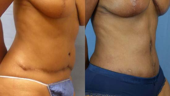 Female body, before and after Tummy Tuck treatment, r-side oblique view, patient 10
