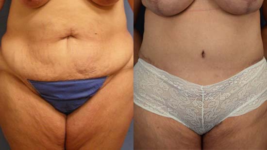 Female body, before and after Tummy Tuck treatment, front view, patient 33
