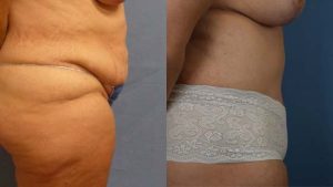  Female body, before and after Tummy Tuck treatment, r-side view, patient 3