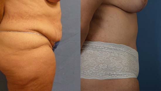 Female body, before and after Tummy Tuck treatment, r-side view, patient 33