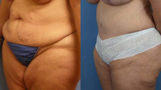 Female body, before and after Tummy Tuck treatment, l-side oblique view, patient 33