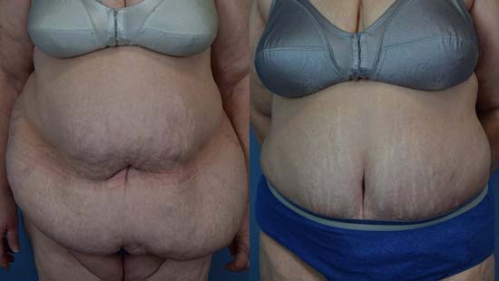 Female body, before and after Tummy Tuck treatment, front view, patient 39