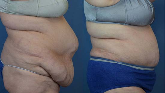 Female body, before and after Tummy Tuck treatment, r-side view, patient 39