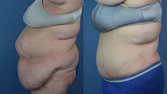  Female body, before and after Tummy Tuck treatment, l-side view, patient 4