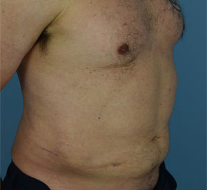 Liposuction Before & After Patient12