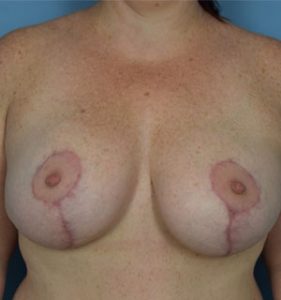 Breast Lift Before & After Patient Miniature Set