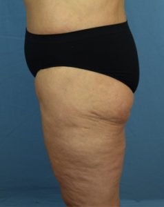Liposuction Before & After Patient7