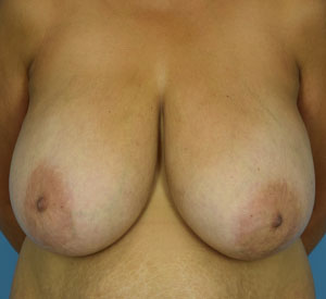 Breast Reduction Before & After Patient6