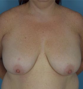 Breast Lift Before & After Patient5