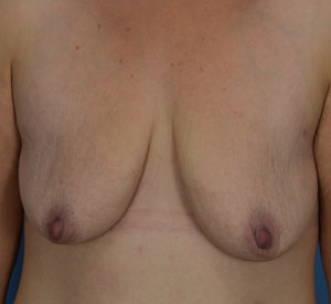 Breast Lift Before & After Patient6
