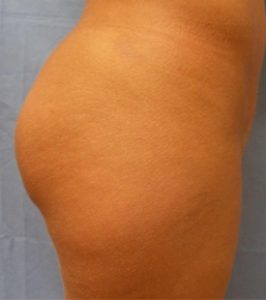 Brazilian Butt Lift Before & After Patient Miniature Set