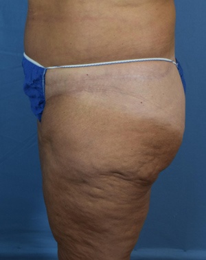 Thigh Lift Before & After Patient Set