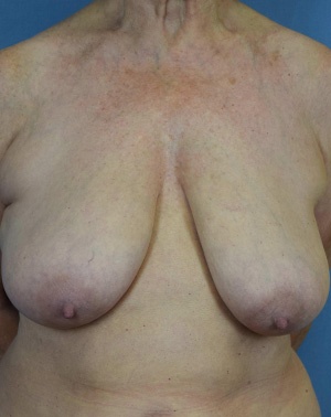 Female breast, before Breast Lift treatment, front view