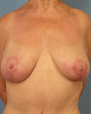 Female breast, after Breast Lift treatment, front view
