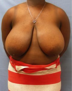 Breast Reduction Before & After Patient1