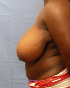 Breast Reduction Before & After Patient Miniature Set