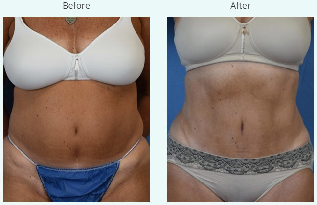 Woman's body, before and after Liposuction treatment, front view