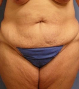 Liposuction Before & After Patient2