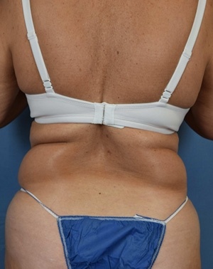 Liposuction Before & After Patient Set