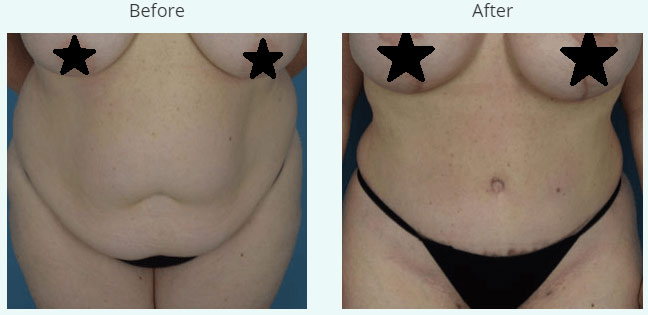 Female body, before and after Tummy Tuck treatment, front view, patient 1