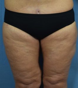 Thigh Lift Before & After Patient Miniature Set