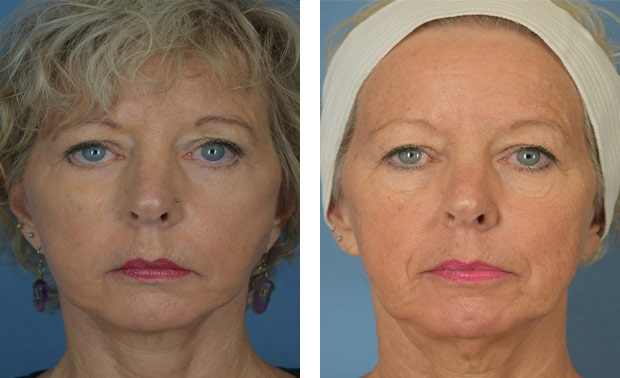 Woman's face, before and after Facelift treatment, front view, patient 1