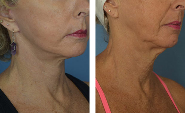 Woman's neck, before and after neck lift treatment, oblique view, patient 1