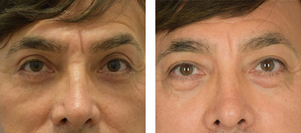 Male face, before and after Brow Lift treatment, front view, patient 2