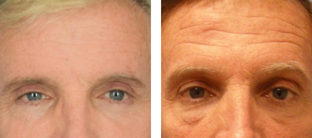 Male face, before and after Rhinoplasty treatment, front view, patient 3