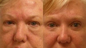  Female face, Eyelid Surgery Before and After treatment photo, front view patient 1