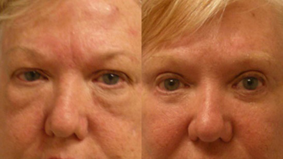 Female face, Eyelid Surgery Before and After treatment photo, front view patient 1