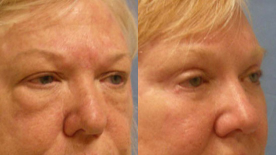 Female face, Eyelid Surgery Before and After treatment photo, r-side oblique view patient 1