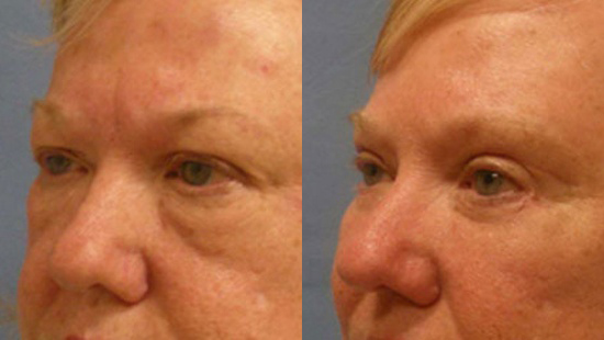 Female face, Eyelid Surgery Before and After treatment photo, l-side oblique view patient 1