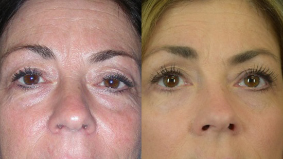  Female face, Eyelid Surgery Before and After treatment photo, front view patient 2