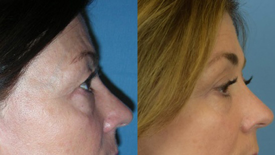 Female face, Eyelid Surgery Before and After treatment photo, r-side view patient 2